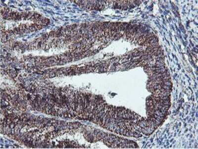 Immunohistochemistry: REEP2 Antibody (OTI2C7) - Azide and BSA Free [NBP2-73849] - Staining of paraffin-embedded Adenocarcinoma of Human endometrium tissue using anti-REEP2 mouse monoclonal antibody.