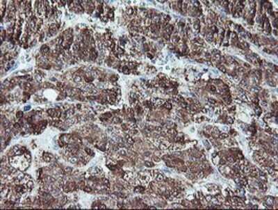 Immunohistochemistry: REEP2 Antibody (OTI2C7) - Azide and BSA Free [NBP2-73849] - Staining of paraffin-embedded Carcinoma of Human liver tissue using anti-REEP2 mouse monoclonal antibody.
