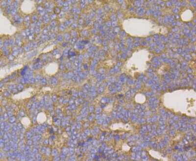 Immunohistochemistry: RENT1/UPF1/hUPF1 Antibody (JG38-44) [NBP2-76842] - Immunohistochemical analysis of paraffin-embedded human prostate cancer tissue using anti-hUPF1 antibody. Counter stained with hematoxylin.