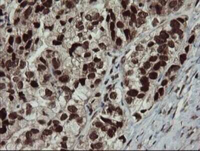 Immunohistochemistry: RFC2 Antibody (OTI2B2) - Azide and BSA Free [NBP2-73857] - Analysis of Adenocarcinoma of Human ovary tissue.