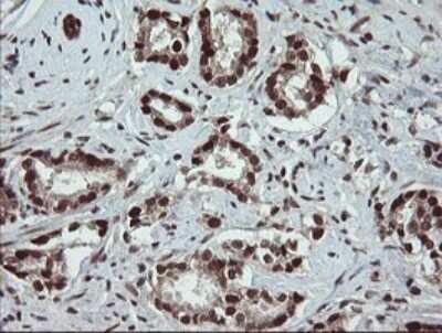 Immunohistochemistry: RFC2 Antibody (OTI2B2) - Azide and BSA Free [NBP2-73857] - Analysis of Carcinoma of Human prostate tissue.