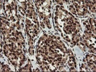 Immunohistochemistry: RFC2 Antibody (OTI2B2) - Azide and BSA Free [NBP2-73857] - Analysis of Carcinoma of Human thyroid tissue.