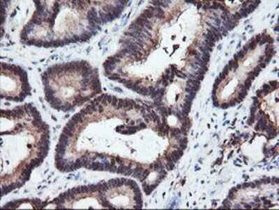 Immunohistochemistry-Paraffin: RFPL3 Antibody (2G4) [NBP2-02034] - Staining of paraffin-embedded Adenocarcinoma of Human colon tissue using anti-RFPL3 mouse monoclonal antibody.