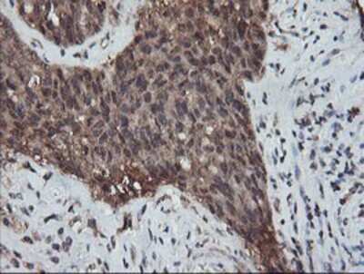 Immunohistochemistry-Paraffin: RFPL3 Antibody (2G4) [NBP2-02034] - Staining of paraffin-embedded Adenocarcinoma of Human ovary tissue using anti-RFPL3 mouse monoclonal antibody.