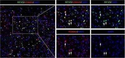 Immunohistochemistry: RFX5 Antibody [NBP1-86041] - The co-expression of RFX5 and KDM4A in HCC tissues was determined by the immunofluorescence staining. The white arrows pointed HCC cells which co-expressed RFX5 and KDM4A. Image collected and cropped by CiteAb from the following publication (//pubmed.ncbi.nlm.nih.gov/32883983/) licensed under a CC-BY license.