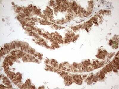 Immunohistochemistry: RGL2 Antibody (OTI10F2) - Azide and BSA Free [NBP2-73875] - Staining of paraffin-embedded Adenocarcinoma of Human ovary tissue using anti-RGL2 mouse monoclonal antibody.