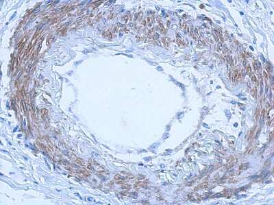 Immunohistochemistry-Paraffin: RGL4 Antibody [NBP2-20145] - Immunohistochemical analysis of paraffin-embedded colon ca, using antibody at 1:500 dilution.