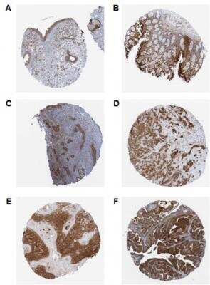 Immunohistochemistry-Paraffin: RIG-I Antibody (Alme-1) [NBP2-80055] - Immunohistochemical staining of endogenous human RIG-I in different human tissues (paraffin sections) using anti-RIG-I, mAb (Alme-1). Different human normal tissues (A: Nasopharynx; B: Colon; C: Endometrium) or cancer tissues (D: Breast; E: Skin; F: Ovarian) were stained with anti-RIG-I, mAb (Alme-1) by standard immunohistochemistry.