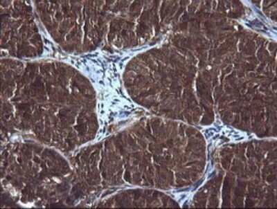 Immunohistochemistry: RIG-I Antibody (OTI6C1) [NBP2-45678] - Analysis of Adenocarcinoma of Human ovary tissue. (Heat-induced epitope retrieval by 10mM citric buffer, pH6.0, 120C for 3min)