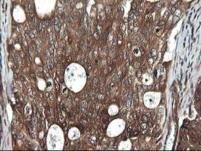 Immunohistochemistry: RIG-I Antibody (OTI6C1) [NBP2-45678] - Analysis of Adenocarcinoma of Human breast tissue. (Heat-induced epitope retrieval by 10mM citric buffer, pH6.0, 120C for 3min)