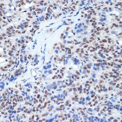 Immunohistochemistry-Paraffin: RING1 Antibody (2Q8D5) [NBP3-15893] - Immunohistochemistry of paraffin-embedded human thyroid cancer using RING1 Rabbit mAb (NBP3-15893) at dilution of 1:100 (40x lens).Perform microwave antigen retrieval with 10 mM Tris/EDTA buffer pH 9.0 before commencing with IHC staining protocol.