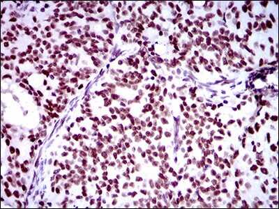 Immunohistochemistry-Paraffin: RING1 Antibody (8C12F4) [NBP2-37370] - Analysis of cervical cancer tissues using Ring1 mouse mAb with DAB staining.