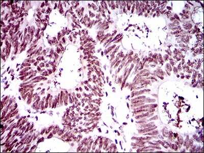 Immunohistochemistry-Paraffin: RING1 Antibody (8C12F4) [NBP2-37370] - Analysis of rectum cancer tissues using Ring1 mouse mAb with DAB staining.