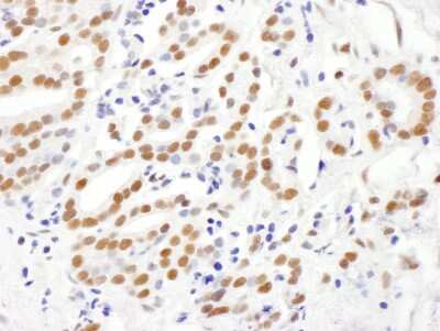 Immunohistochemistry: RING1 Antibody [NBP2-04111] - Sample: FFPE section of human prostate carcinoma. Antibody: Affinity purified rabbit anti- RING1 used at a dilution of 1:1,000 (1ug/ml). Detection: DAB. Counterstain: Hematoxylin (blue).