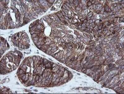Immunohistochemistry: RIOK2 Antibody (OTI3E11) - Azide and BSA Free [NBP2-73910] - Analysis of Adenocarcinoma of Human ovary tissue.