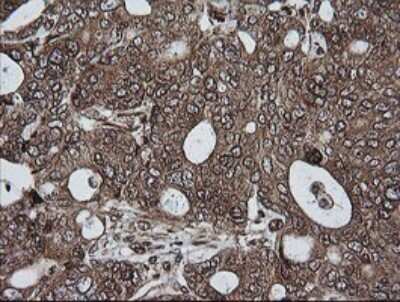 Immunohistochemistry: RIOK2 Antibody (OTI3E11) [NBP2-45960] - Analysis of Adenocarcinoma of Human breast tissue.