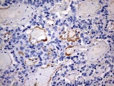 Immunohistochemistry: RIPK3/RIP3 Antibody (OTI1B3) - Azide and BSA Free [NBP2-73912] - Analysis of Carcinoma of Human pancreas tissue using RIPK3/RIP3 Antibody [NBP2-45592]. (Heat-induced epitope retrieval by 1 mM EDTA in 10mM Tris, pH9.0, 120C for 3min)