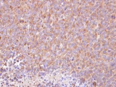 Immunohistochemistry-Paraffin: RIPK5 Antibody [NBP1-32646] - Paraffin-embedded H1299 xenograft, using antibody at 1:100 dilution.
