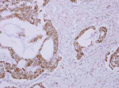 Immunohistochemistry-Paraffin: RLBP1L1 Antibody [NBP2-20170] - Paraffin-embedded lung adenocarcinoma. RLBP1L1 antibody dilution: 1:500.