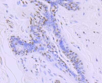 Immunohistochemistry-Paraffin: RNA Polymerase II/POLR2A [ac Ser5] Antibody (JM51-21) [NBP2-66801] - Analysis of paraffin-embedded human breast cancer tissue using anti- Phospho-POLR2A (S5) antibody. Counter stained with hematoxylin.