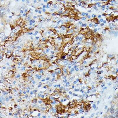 Immunohistochemistry-Paraffin: RNASE6 Antibody [NBP2-94645] - Paraffin-embedded human lung cancer using RNASE6 .