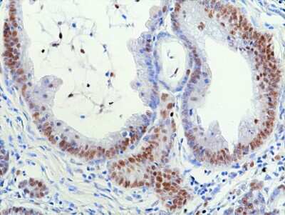 Immunohistochemistry-Paraffin: RNASEH2B Antibody (RM433) [NBP3-09181] - Immunohistochemical staining of formalin fixed and paraffin embedded human colon cancer tissue sections using NBP3-09181 at 1:100 dilution.