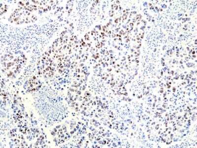 Immunohistochemistry-Paraffin: RNASEH2B Antibody (RM433) [NBP3-09181] - Immunohistochemical staining of formalin fixed and paraffin embedded human lung cancer tissue sections using NBP3-09181 at 1:100 dilution.