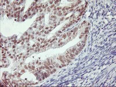Immunohistochemistry: RNF113B Antibody (OTI7A1) - Azide and BSA Free [NBP2-73921] - Staining of paraffin-embedded Adenocarcinoma of Human endometrium tissue using anti-RNF113B mouse monoclonal antibody.