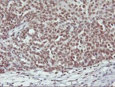 Immunohistochemistry: RNF113B Antibody (OTI7A1) - Azide and BSA Free [NBP2-73921] - Staining of paraffin-embedded Adenocarcinoma of Human ovary tissue using anti-RNF113B mouse monoclonal antibody.