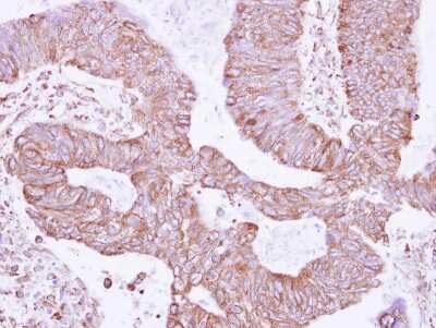 Immunohistochemistry-Paraffin: RNF181 Antibody [NBP2-20181] - Immunohistochemical analysis of paraffin-embedded Colon ca, using antibody at 1:500 dilution.