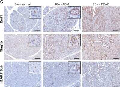 Immunohistochemistry: RNF2 Antibody [NBP1-49966] - Epigenetic remodelers were overexpressed in pancreatitis and pancreatic cancer. Immunohistochemistry staining against Bmi1, Ring1b (RNF2) and H2AK119ub of pancreatic tissue from three week old KPC mice representing morphological normal tissue, from ten week old mice showing preinvasive ductal lesions and from 20 week old KPC mice demonstrating full PDAC (n = 5). High magnification images represent nuclear staining of centroacinar cells (3w-normal) or ADMs (10w-ADM). Bar, 100 um. Image collected and cropped by CiteAb from the following publication (//www.oncotarget.com/fulltext/6717), licensed under a CC-BY license.