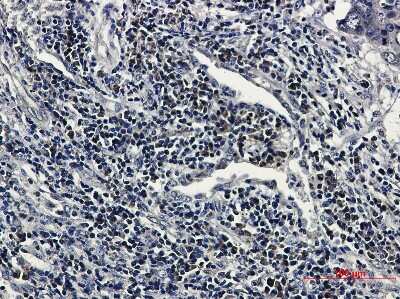 Immunohistochemistry: RNF2 Antibody (S04-2B3) [NBP3-14971] - Immunohistochemical of RNF2 in Human lung cancer tissue using RNF2 antibody at dilution 1/50