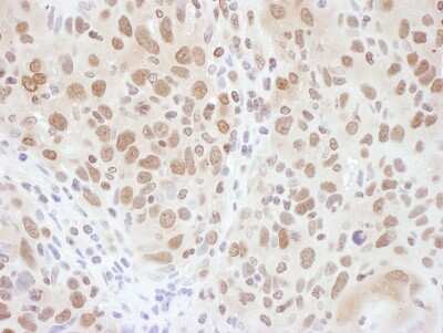 <b>Biological Strategies Validation. </b>Immunohistochemistry-Paraffin: RNF20 Antibody [NB100-2243] - Sample: FFPE section of human ovarian carcinoma. Antibody: Affinity purified rabbit anti- RNF20 used at a dilution of 1:1,000 (1ug/ml). Detection: DAB