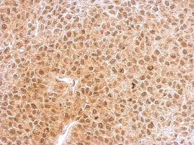 Immunohistochemistry-Paraffin: RNF25 Antibody [NBP1-31491] -  HeLa xenograft. RNF25 antibody [C2C3], C-term dilution: 1:500. Antigen Retrieval: Trilogy™ (EDTA based, pH 8.0) buffer, 15min.