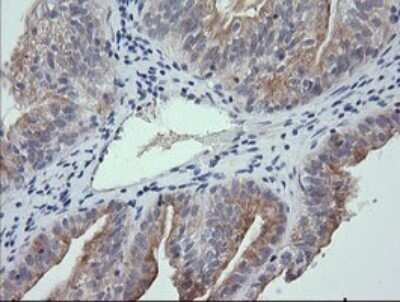 Immunohistochemistry: RNF39 Antibody (OTI5E10) - Azide and BSA Free [NBP2-73927] - Analysis of Adenocarcinoma of Human ovary tissue. (Heat-induced epitope retrieval by 10mM citric buffer, pH6.0, 120C for 3min)