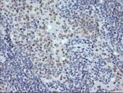 Immunohistochemistry: RNF39 Antibody (OTI5E10) - Azide and BSA Free [NBP2-73927] - Analysis of Human lymphoma tissue. (Heat-induced epitope retrieval by 10mM citric buffer, pH6.0, 120C for 3min)