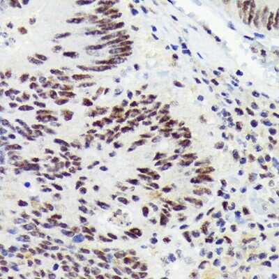 Immunohistochemistry-Paraffin: RNF40 Antibody (8I7R5) [NBP3-16834] - Immunohistochemistry of paraffin-embedded human colon carcinoma using RNF40 Rabbit mAb (NBP3-16834) at dilution of 1:100 (40x lens).Perform microwave antigen retrieval with 10 mM Tris/EDTA buffer pH 9.0 before commencing with IHC staining protocol.