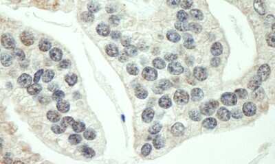 <b>Independent Antibodies Validation and Biological Strategies Validation.</b>Immunohistochemistry-Paraffin: RNF40 Antibody [NB100-2247] - Sample: FFPE section of human prostate carcinoma. Antibody: Affinity purified rabbit anti- RNF40 used at a dilution of 1:1,000 (1ug/ml). Detection: DAB