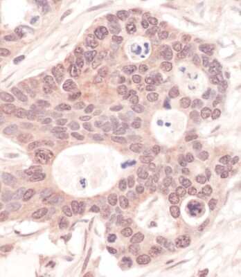 Immunohistochemistry-Paraffin: RNGTT Antibody [NBP1-49973] - Section of human ovarian carcinoma. Antibody: Affinity purified rabbit anti- RNGTT used at a dilution of 1:200 (1ug/ml). Detection: Vector Laboratories ImmPACT NovaRED Peroxidase Substrate.