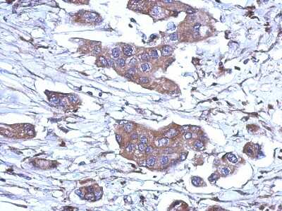 Immunohistochemistry-Paraffin: RNase H1 Antibody [NBP2-20171] - Human breast cancer, using RNase H1 antibody at 1:500 dilution. Antigen Retrieval: Trilogy™ (EDTA based, pH 8.0) buffer, 15min.