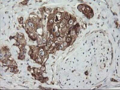 Immunohistochemistry: ROMO1 Antibody (OTI2C12) - Azide and BSA Free [NBP2-73928] - Analysis of Adenocarcinoma of Human breast tissue.