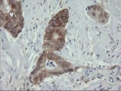 Immunohistochemistry: ROMO1 Antibody (OTI2C12) - Azide and BSA Free [NBP2-73928] - Analysis of Adenocarcinoma of Human colon tissue.