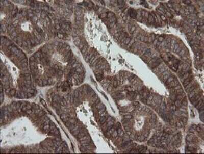 Immunohistochemistry: ROMO1 Antibody (OTI2C12) - Azide and BSA Free [NBP2-73928] - Analysis of Adenocarcinoma of Human endometrium tissue.