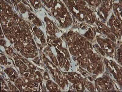 Immunohistochemistry: ROMO1 Antibody (OTI2C12) - Azide and BSA Free [NBP2-73928] - Analysis of Carcinoma of Human thyroid tissue.