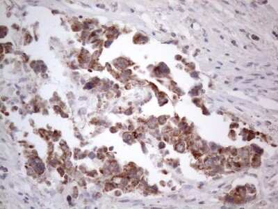 Immunohistochemistry: ROR beta Antibody (OTI1G1) [NBP2-45610] -  ROR beta Antibody (1G1) [NBP2-45610] - Analysis of Adenocarcinoma of Human breast tissue. (Heat-induced epitope retrieval by 1mM EDTA in 10mM Tris buffer (pH8.5) at 120 degrees C for 3 min)