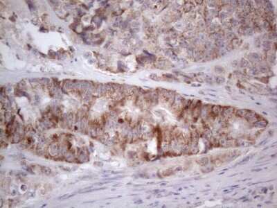 Immunohistochemistry: ROR beta Antibody (1G1) [NBP2-45610] - Analysis of Adenocarcinoma of Human colon. (Heat-induced epitope retrieval by 1mM EDTA in 10mM Tris buffer (pH8.5) at 120C for 3 min)