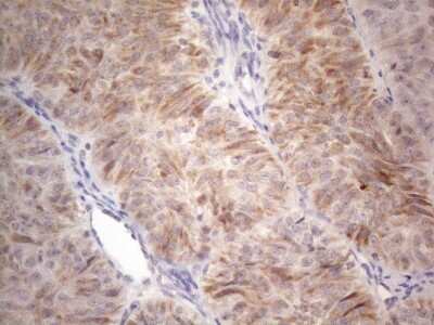 Immunohistochemistry: ROR beta Antibody (1G1) [NBP2-45610] - Analysis of Adenocarcinoma of Human ovary tissue. (Heat-induced epitope retrieval by 1mM EDTA in 10mM Tris buffer (pH8.5) at 120C for 3 min)