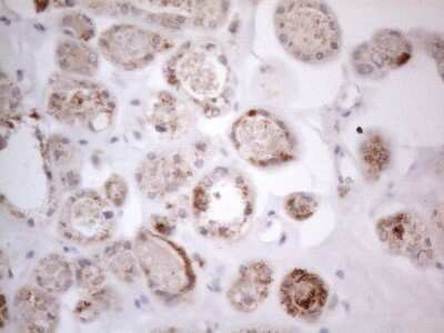 Immunohistochemistry: ROR beta Antibody (1G1) [NBP2-45610] - Analysis of Carcinoma of Human thyroid tissue. (Heat-induced epitope retrieval by 1mM EDTA in 10mM Tris buffer (pH8.5) at 120C for 3 min)