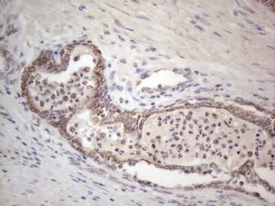 Immunohistochemistry: ROR beta Antibody (1G1) [NBP2-45610] - Analysis of Carcinoma of Human prostate tissue.(Heat-induced epitope retrieval by 1mM EDTA in 10mM Tris buffer (pH8.5) at 120C for 3 min)