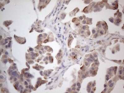 Immunohistochemistry: ROR beta Antibody (1G1) [NBP2-45610] - Analysis of Carcinoma of Human bladder tissue. (Heat-induced epitope retrieval by 1mM EDTA in 10mM Tris buffer (pH8.5) at 120C for 3 min)